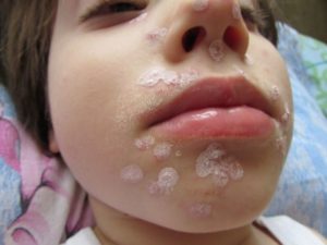 Болячка у ребенка