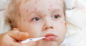 Иммунитет к ветряной оспе