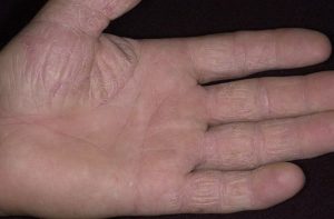 Болит кожа на ладонях рук