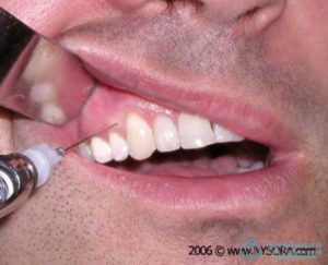 Болит и опухла десна после укола анестезии