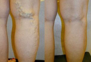 Болит кожа при варикозе