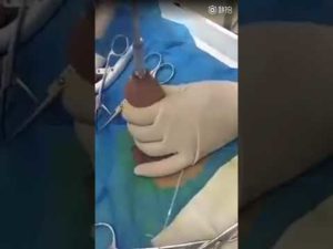 Как остановить кровотечение после обрезания