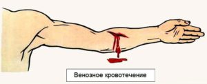Кровь от натуживания, прием таваника