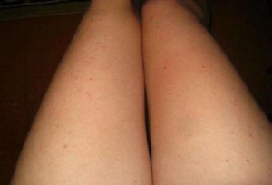 Красные прыщики на ляжках
