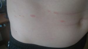 Красные пятна на торсе у мужчины