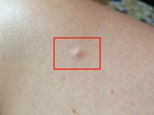 Маленький круглый чуть-чуть выпуклый бугорок