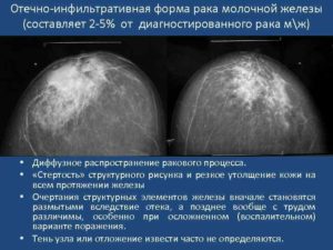 Инфильтративные изменения молочной железы