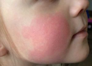 Красная сыпь/головная боль