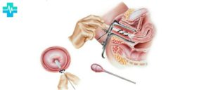 Мазок на онкоцитологию. Беременность 13 нед