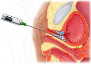 Лечение недержания гиалуроновой кислотой
