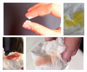 Кровянистые выделения при лечении свечами Макмирор