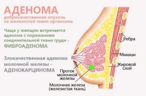 Болит грудь при прикосновении