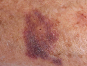 Красно-бордовые пятна на ногах