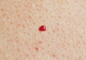 Красная точка на родинке
