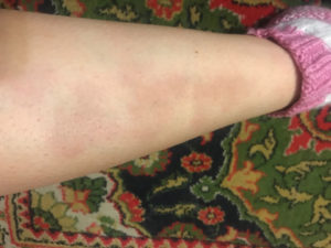 Коричневые пятна на икрах ног