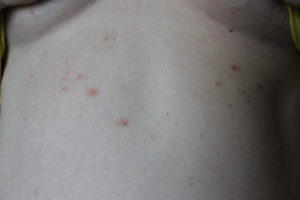 Красные пятна на торсе у мужчины