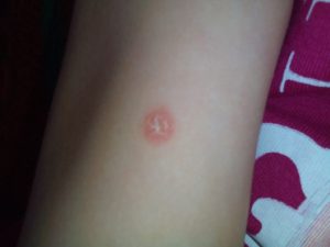 Болячка у ребенка