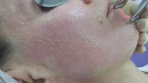 Корочки после лазерной шлифовки