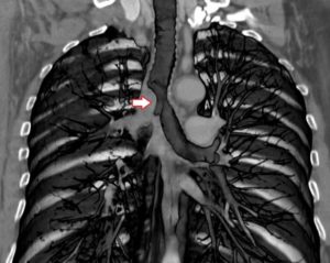 Перибронхиальный отек