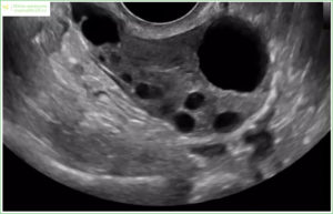 Персистенция фолликула? Дюфастон? Помогите разобраться