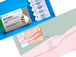 Ихтиоловые свечи куда вставлять