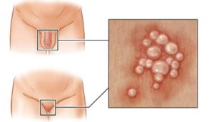 Красные волдыри на половом члене