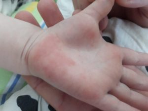 Красные ладошки, не проходящий зуд у ребенка