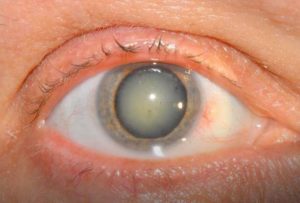 Болит глаз, мутное изображение картинки