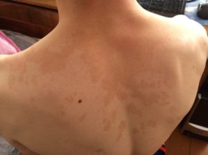 Пигментные пятна на спине
