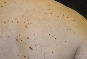 Пигментные пятна на теле