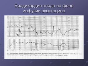 Брадикардия плода
