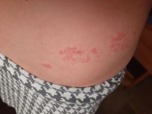 Болит кожа, появилось высыпание