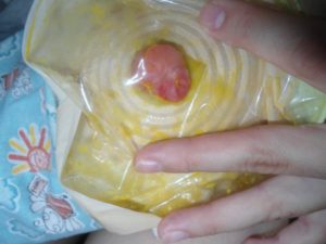 Больно ходить по большому, крови и других выделений подозрительных нет