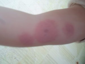 Красные пятна с уплотнением чешутся (шишки)