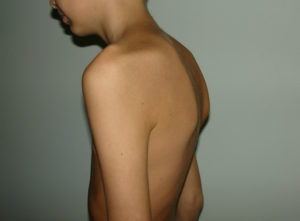 Болезнь Шейермана-Мау