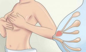 Лактостаз после перетягивания груди