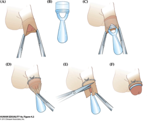 Как остановить кровотечение после обрезания