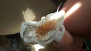 Коричневые выделения и зуд после менструации