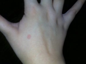 Красные, круглые пятна на руке, небольшие