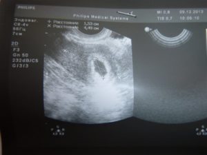 Кровотечение на 7 недели беременности