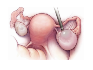 Киста на левом яичнике, объясните правильное ли у меня лечение