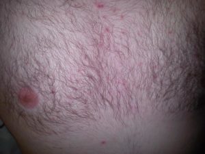 Красные пятна на торсе у мужчины