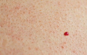 Маленькие красные точки на теле