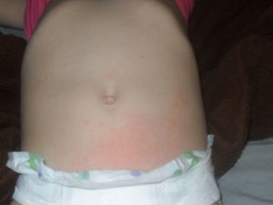 Красные пятна внизу живота у ребенка