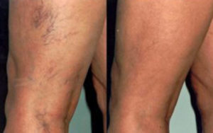 Массаж после склеротеропии