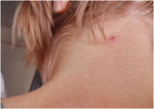 Красные высыпания прыщей, на шее сзади