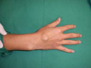 Красные мягкие шишки возле суставов пальца