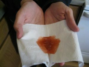 Больно ходить по большому, крови и других выделений подозрительных нет