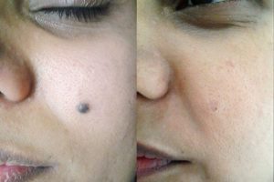 Пигмент после удаление родинки