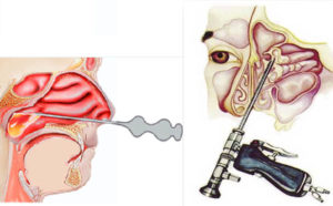 Кровь после гайморотомии